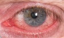 Rosácea - Presentación clínica